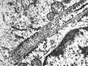 M,41y. | ribosome-lamella complex in tricholeukocyte -hairy cell leukemia, spleen